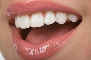 Офисное отбеливание Офисное отбеливание